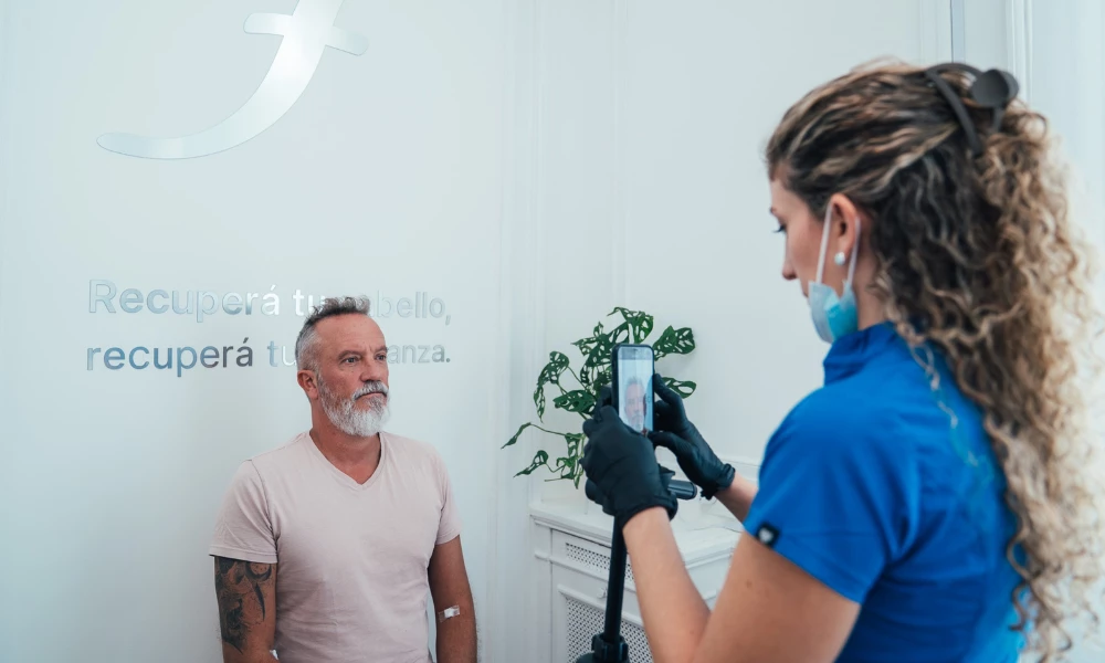 Técnica FUE Zafiro para barba