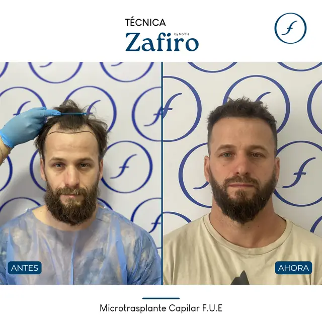 Antes y después de implante capilar FUE Zafiro — caso de paciente Frontis