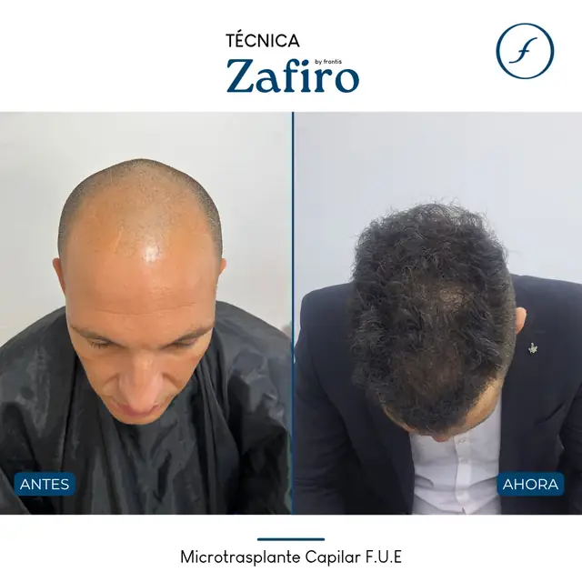 Antes y después de implante capilar FUE Zafiro — caso de paciente Frontis