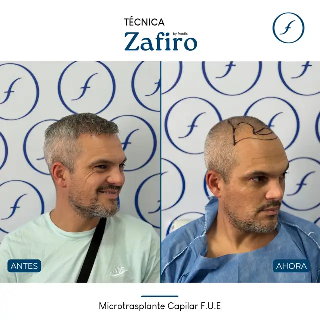 Antes y después de implante capilar FUE Zafiro — caso de paciente Frontis