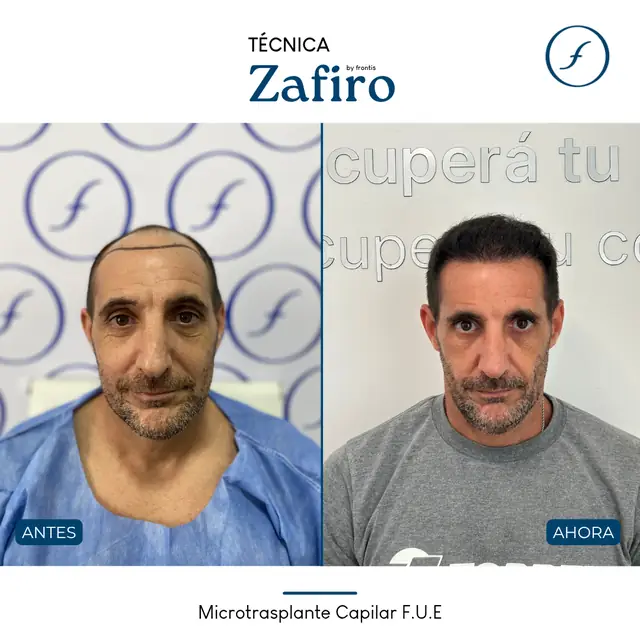 Antes y después de implante capilar FUE Zafiro — caso de paciente Frontis