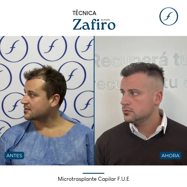 Antes y después de implante capilar FUE Zafiro — caso de paciente Frontis