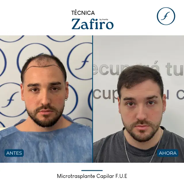 Antes y después de implante capilar FUE Zafiro — caso de paciente Frontis