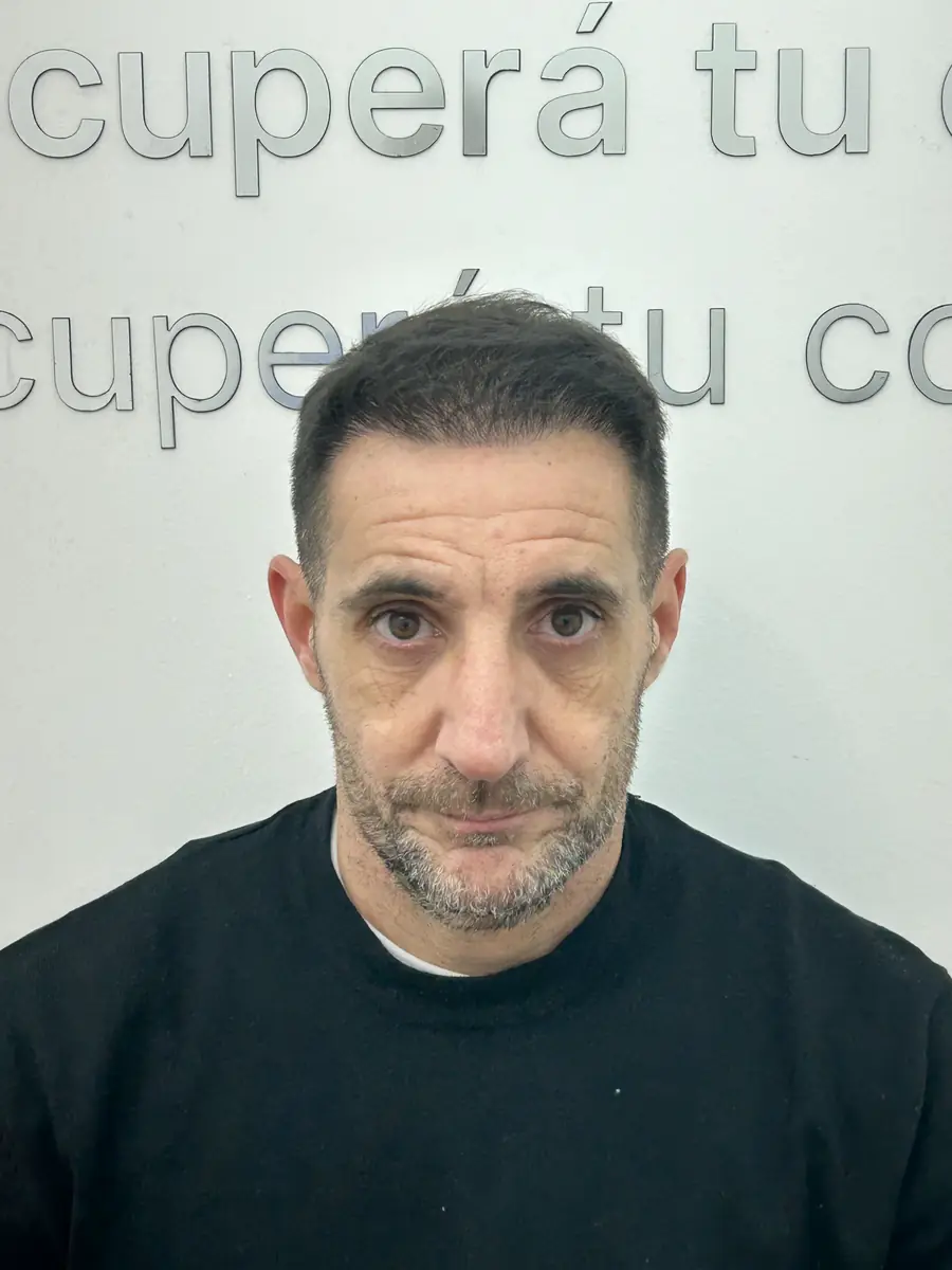 Mes 12 después del implante capilar FUE