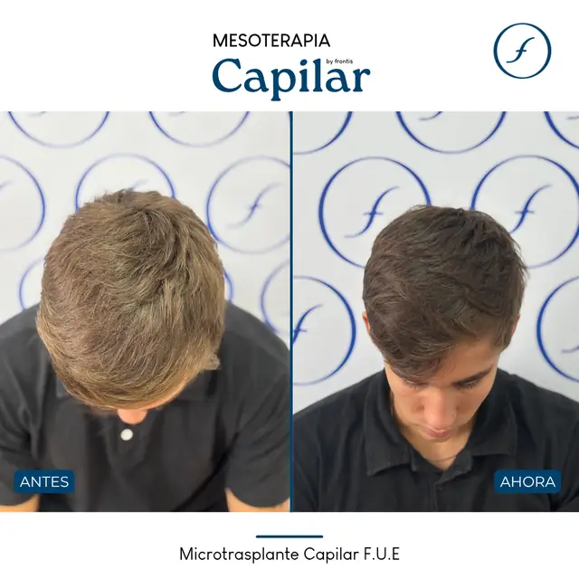 Antes y después de Mesoterapia Capilar — caso de paciente Frontis