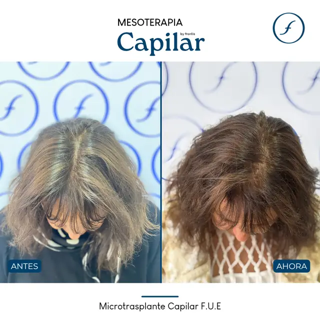 Antes y después de Mesoterapia Capilar — caso de paciente Frontis