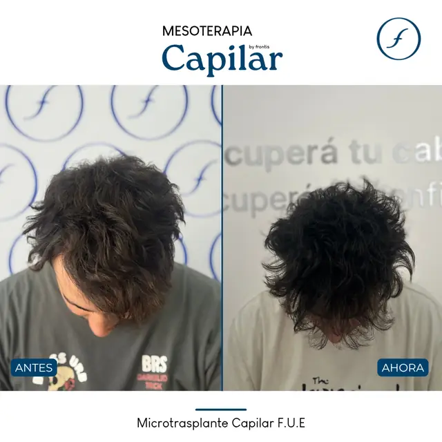 Antes y después de Mesoterapia Capilar — caso de paciente Frontis