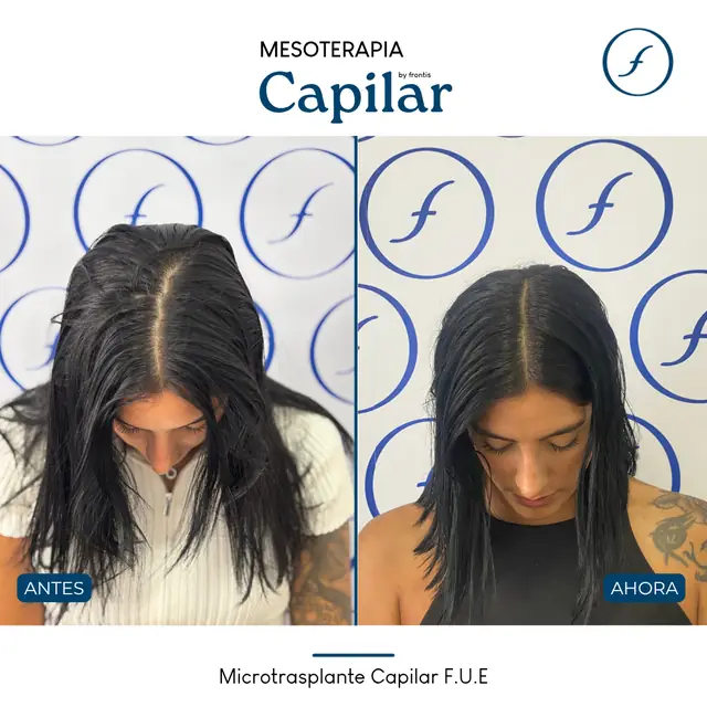 Antes y después de Mesoterapia Capilar — caso de paciente Frontis