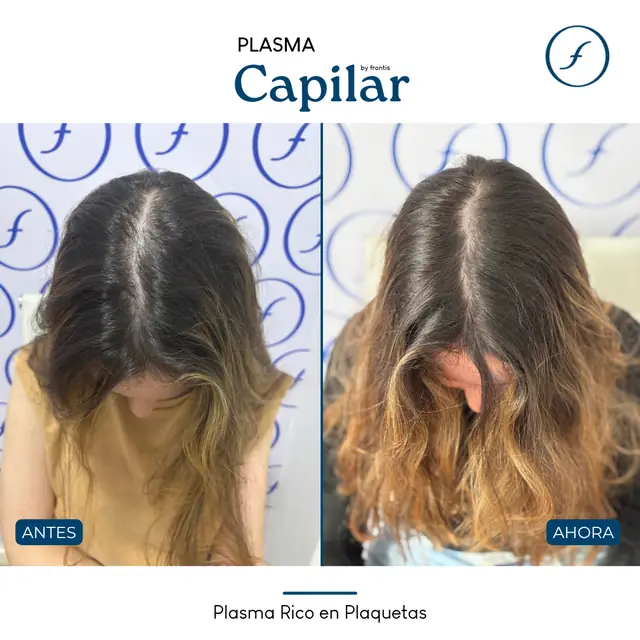 Antes y después de Plasma Rico en Plaquetas — caso de paciente Frontis