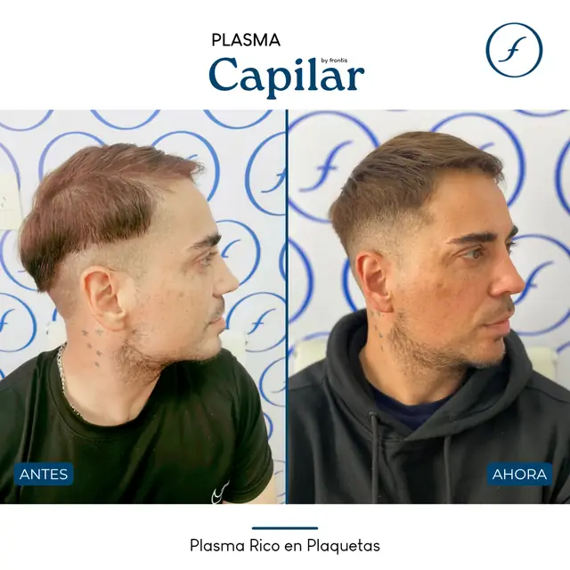 Antes y después de Plasma Rico en Plaquetas — caso de paciente Frontis