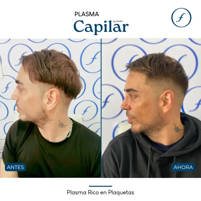 Antes y después de Plasma Rico en Plaquetas — caso de paciente Frontis