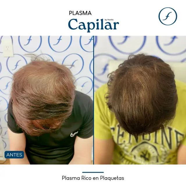 Antes y después de Plasma Rico en Plaquetas — caso de paciente Frontis
