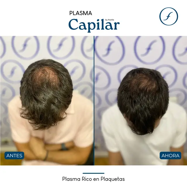 Antes y después de Plasma Rico en Plaquetas — caso de paciente Frontis