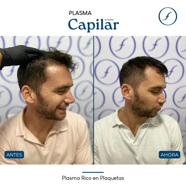 Antes y después de Plasma Rico en Plaquetas — caso de paciente Frontis