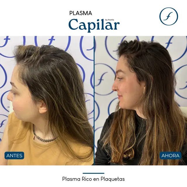 Antes y después de Plasma Rico en Plaquetas — caso de paciente Frontis