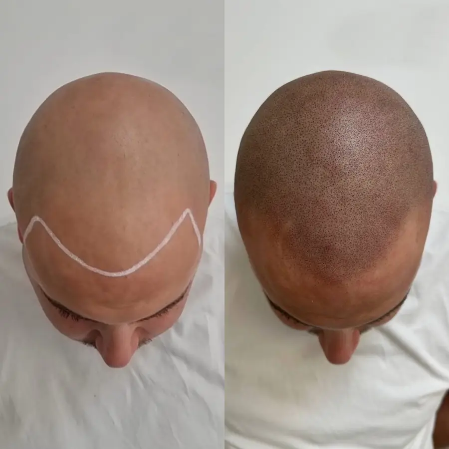 Antes y después de tricopigmentación efecto rapado — caso de paciente Frontis