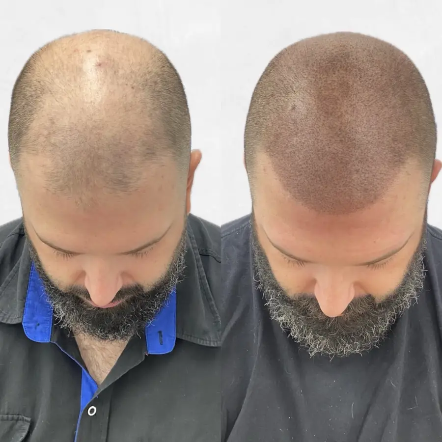 Antes y después de tricopigmentación efecto rapado — caso de paciente Frontis