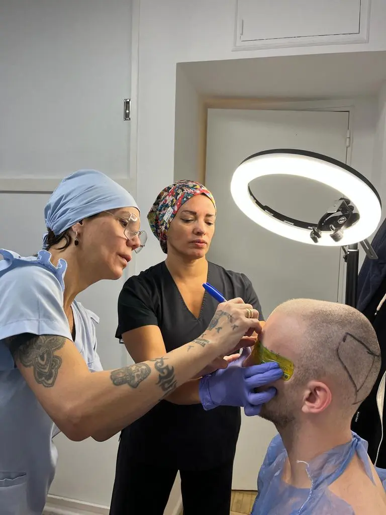 Médicos diagramando la línea de implantación durante un procedimiento de implante capilar, preparando la zona para el injerto de pelo.