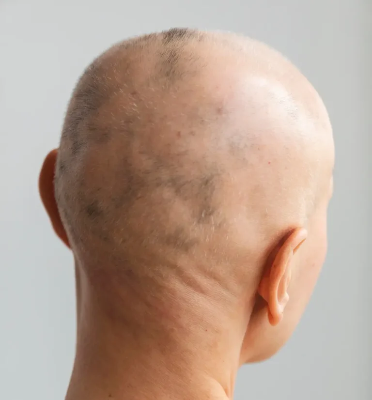 Alopecia areata: causas y tratamientos más efectivos